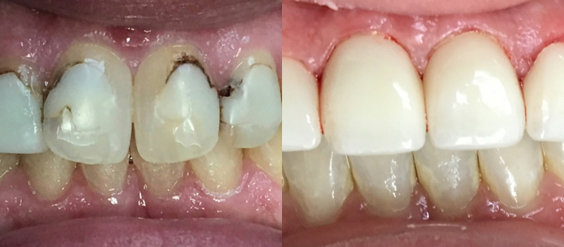 Dental Bridges