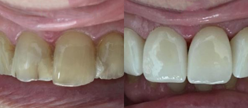 Dental Crowns